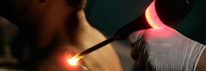 лазеры для удаления татуировок