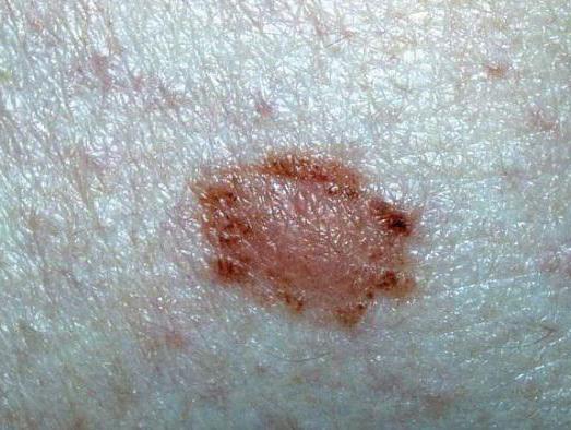 папилломатозный меланоцитарный невус кожи 