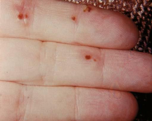 Инфекционный эндокардит фото сыпи thumbnail