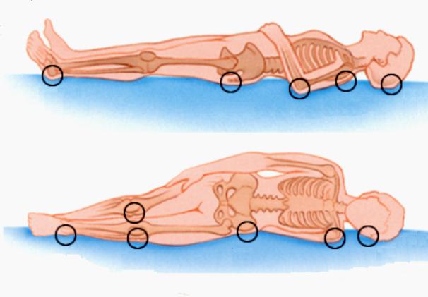 где образуются пролежни