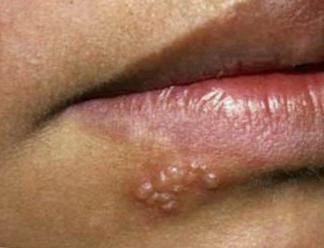 Herpes on the lips as transmitted