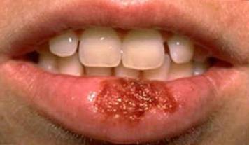 What does herpes look like on the lips?