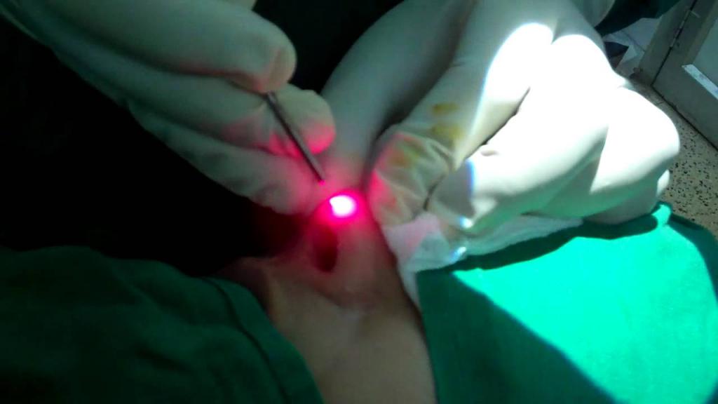 Лазерная хирургия