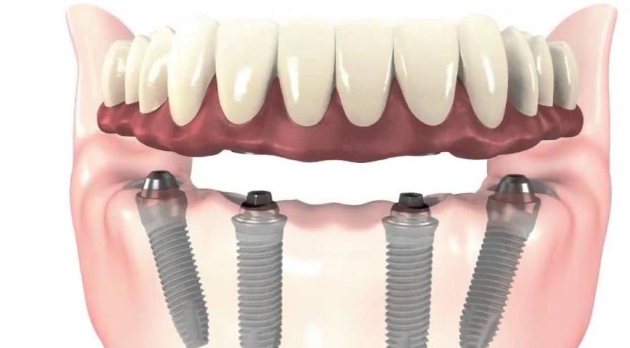 Рейтинг имплантов зубов по производителям и приживаемости