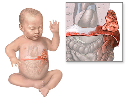 Диафрагмальная грыжа у детей