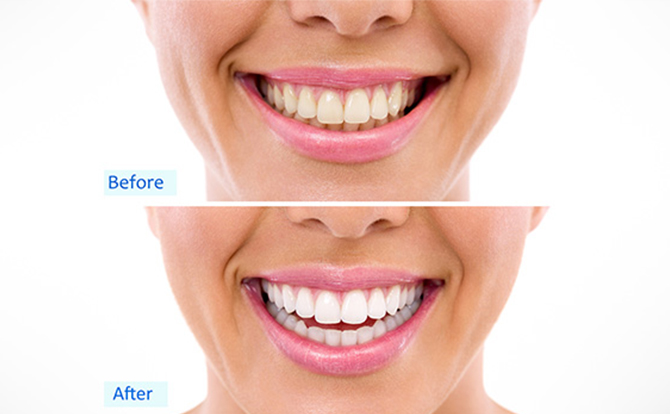 до и после ультразвуковой чистки зубов