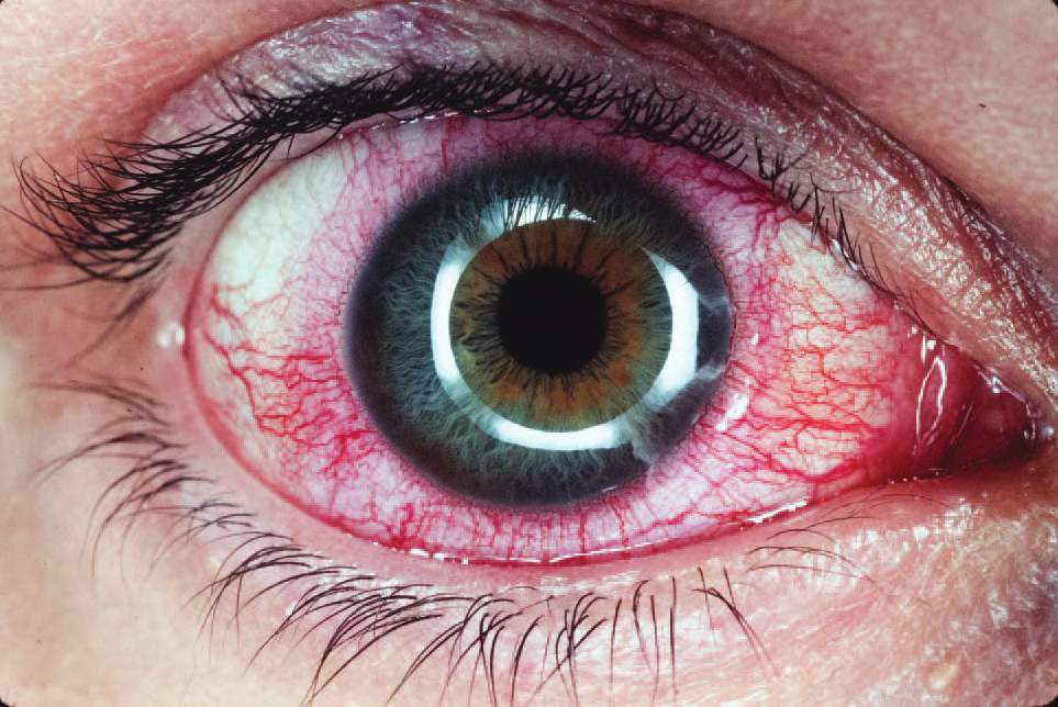 Hemorrhage in the anterior chamber of the eye