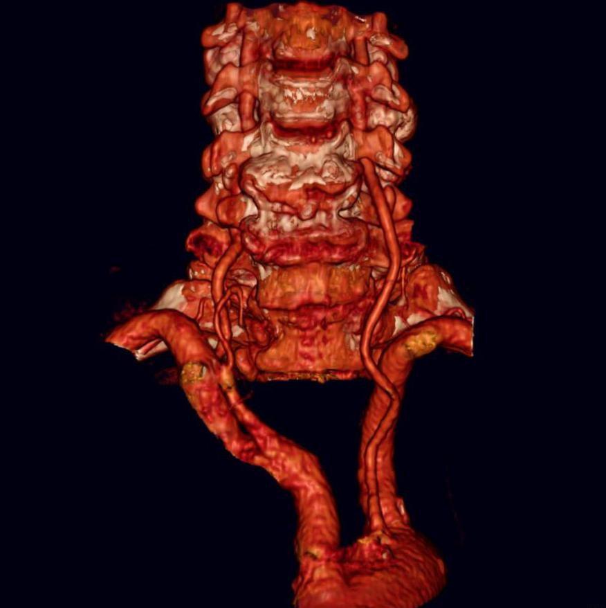 Что значит гипоплазия позвоночной артерии. Позвоночные артерии. Аномалии позвоночных артерий.