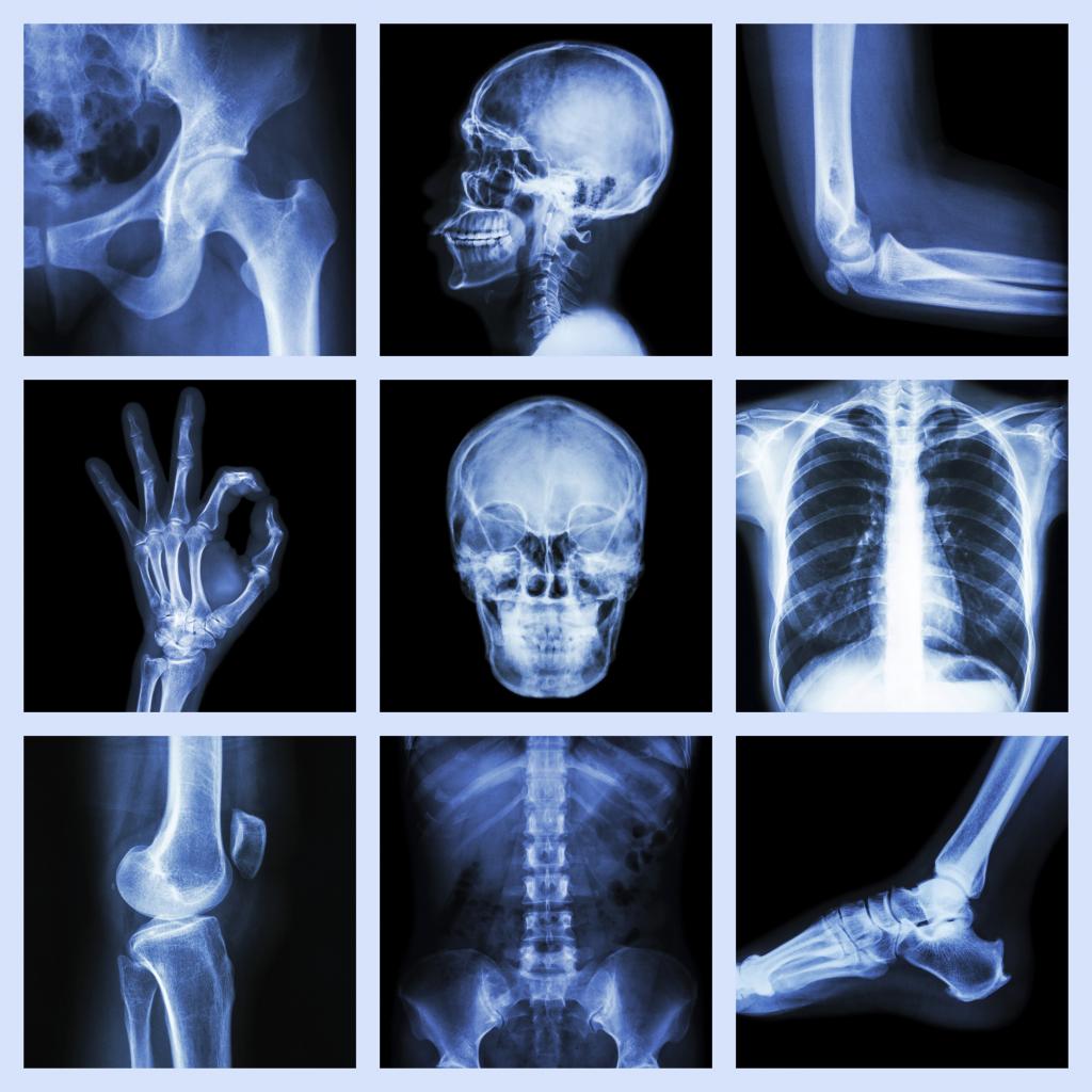 Рентген кости