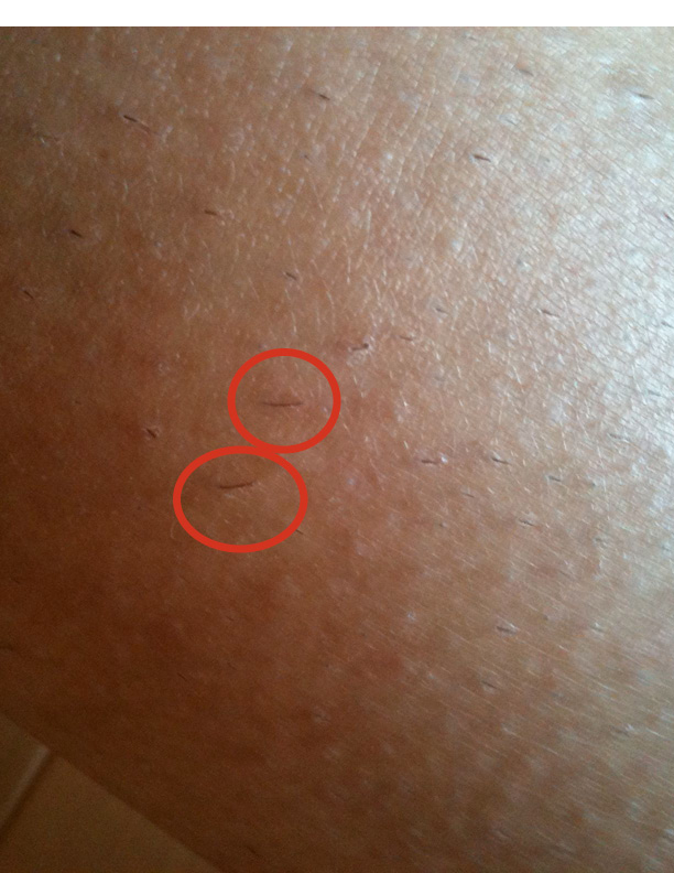 A lot of ingrown hair