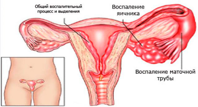 виды воспалительного процесса