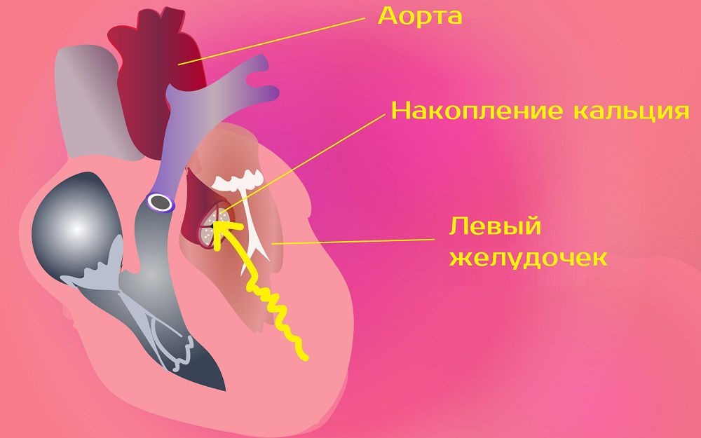 Кальциноз стенок