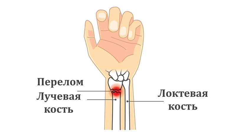 Перелом лучевой кости руки локтя. Сгибательный перелом лучевой кости. Лучевая кость на руке где находится у человека. Перелом лучевой кости руки. Лучевая кость на руке перелом.