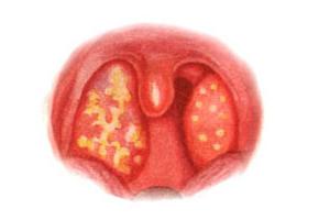 Схема лечения ангины у детей 3 лет thumbnail