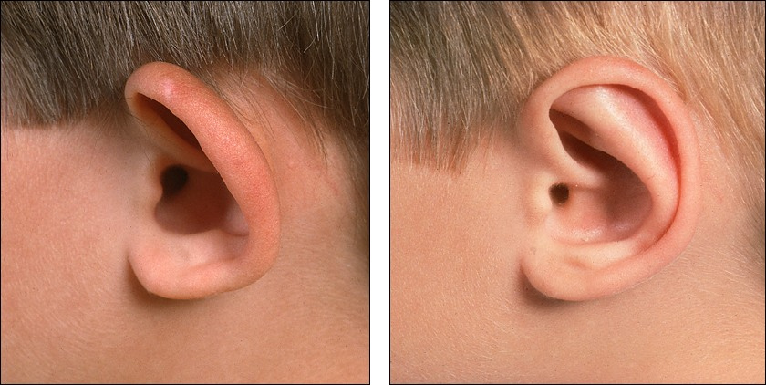 Children's hearing loss