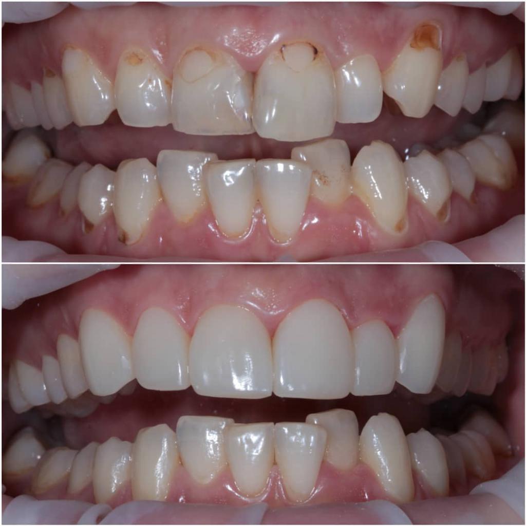 Особенности применения Эстелайт для реставрации зубов