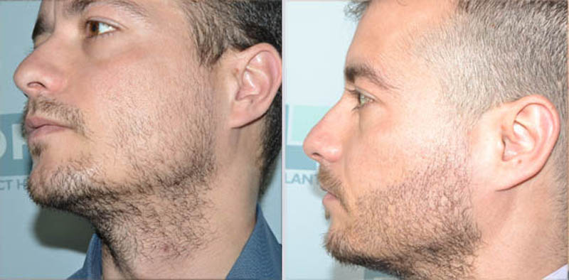 Пересадка волос на бороду: описание метода, техника выполнения, особенности, отзывы