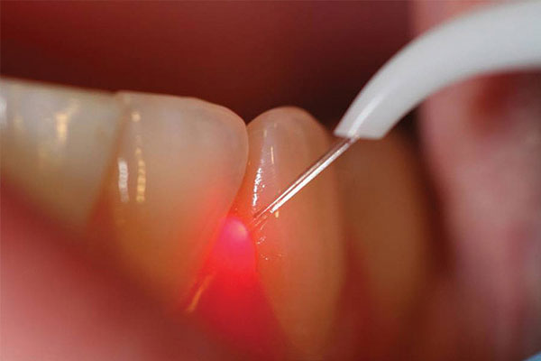 Использование лазера в стоматологии