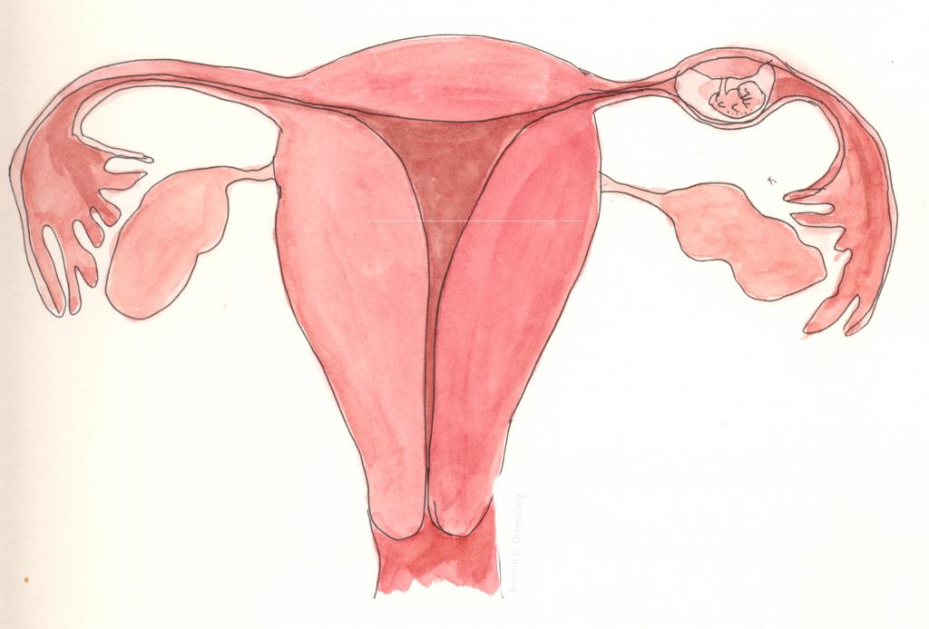 Ectopic pregnancy