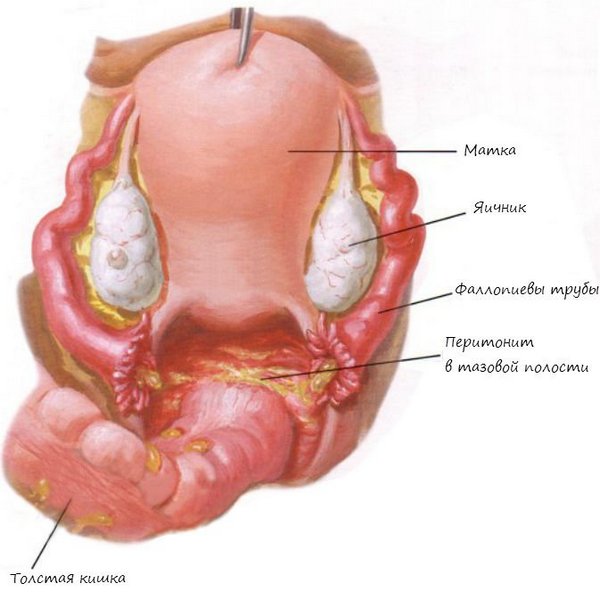 Перитонит в тазовой области