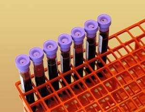 Анализ на гемоглобин в лаборатории