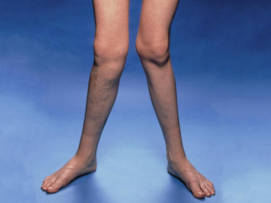 Что такое вальгусное искривление ног?