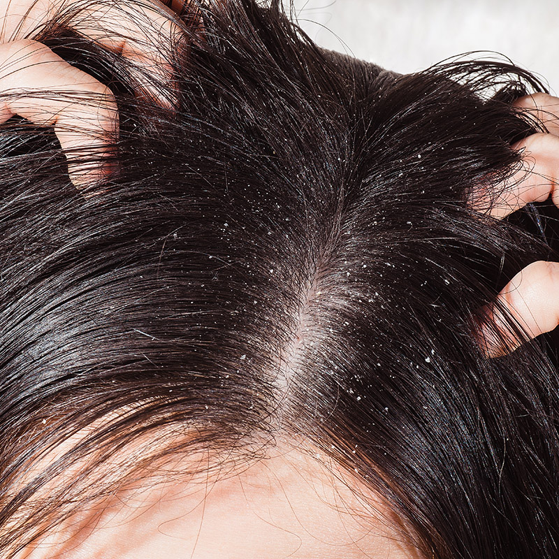 Почему болит кожа головы когда волосы грязные их