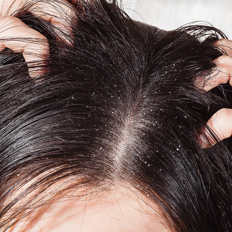 Treatment and prevention of dandruff