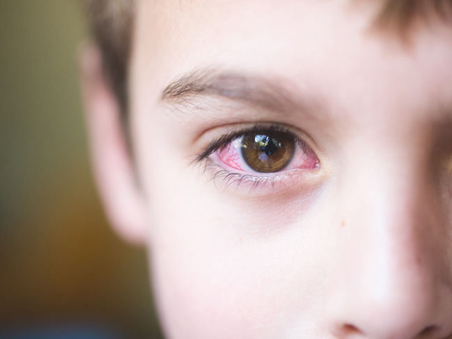 Ребенок с больным глазом