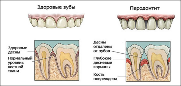 отличие от здоровых зубов