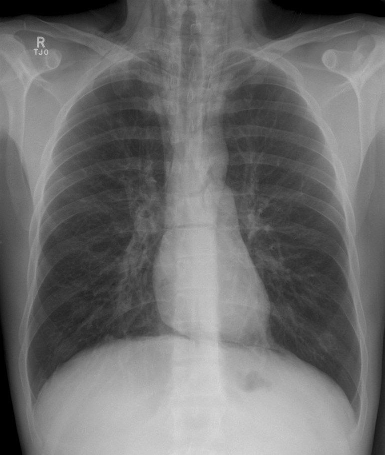 рентген легких с астмой