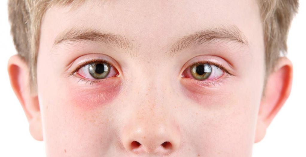 аллергический конъюнктивит у детей