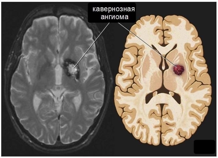 ангиома головного мозга что это