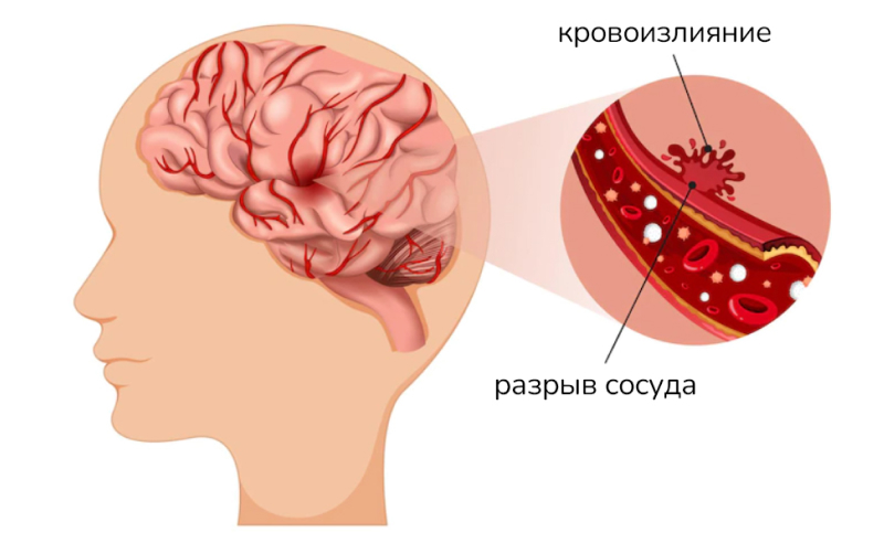 Ангиома мозга лечение. Церебральный атеросклероз.