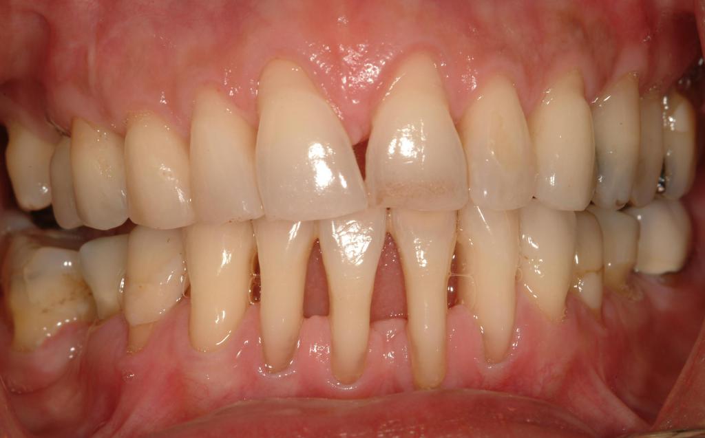 gum inflamed and moved away from the tooth