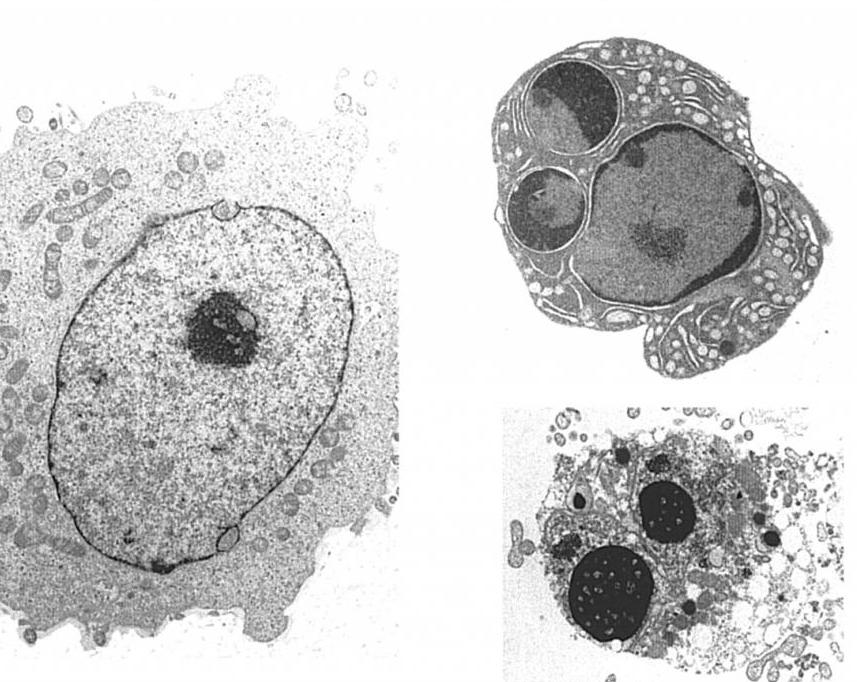 Клетки с гиперхромными ядрами. Апоптоз микрофотография. Апоптоз клетки микроскоп. Клеточный апоптоз. Некроз клетки микрофотографии.