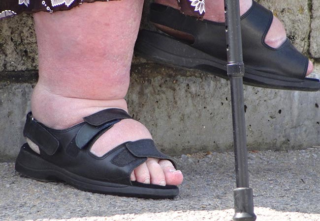 Почему появляются отеки на ногах у пожилых людей, как их правильно лечить. Сильные отёки ног: причины и лечение у пожилых людей