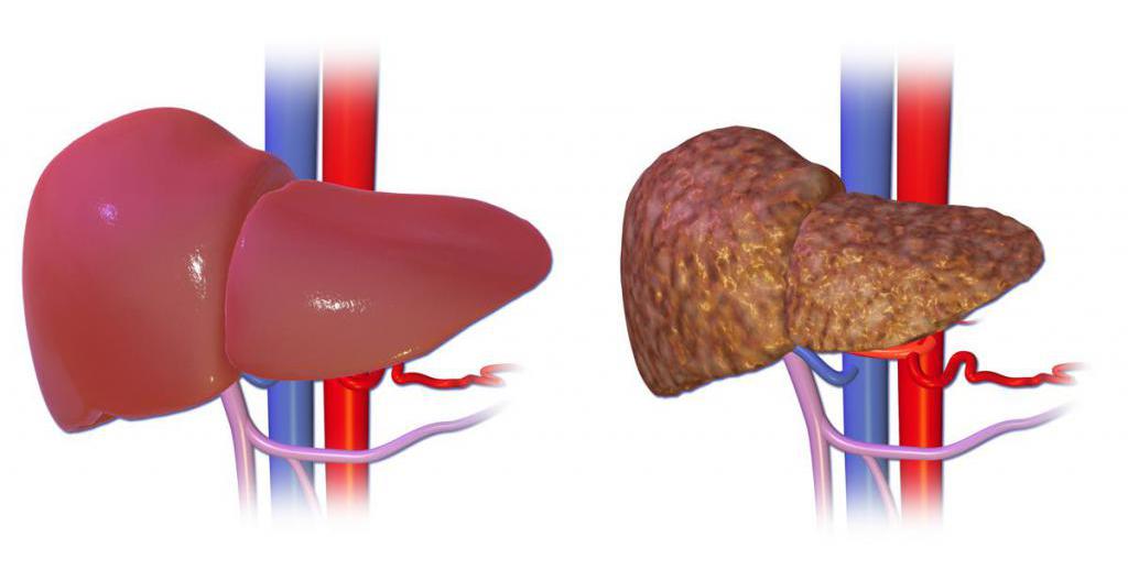 здоровая печень и орган с циррозом
