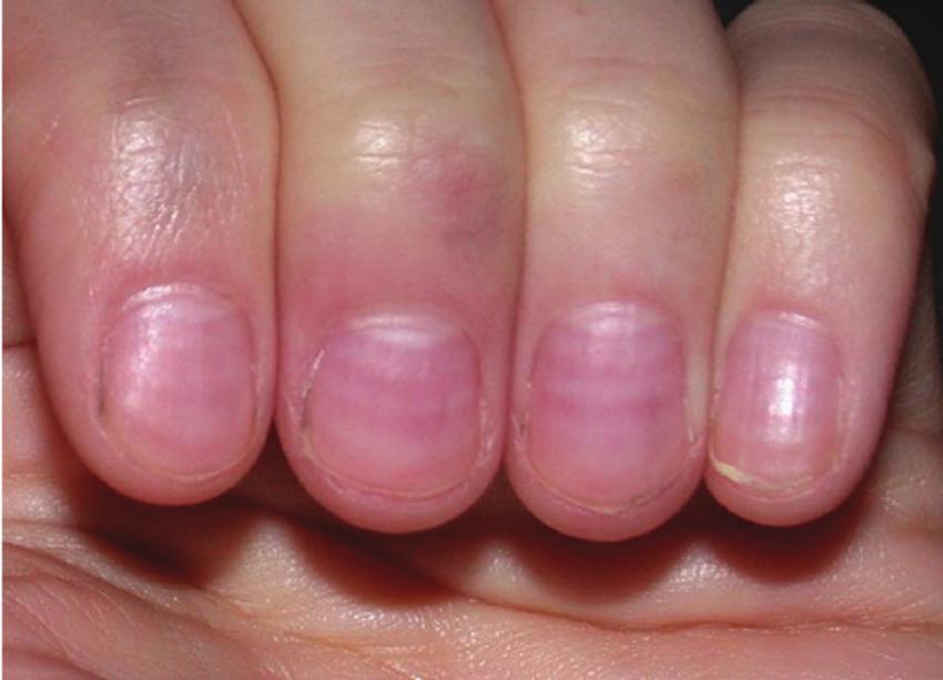 заболевания кожи и ногтей