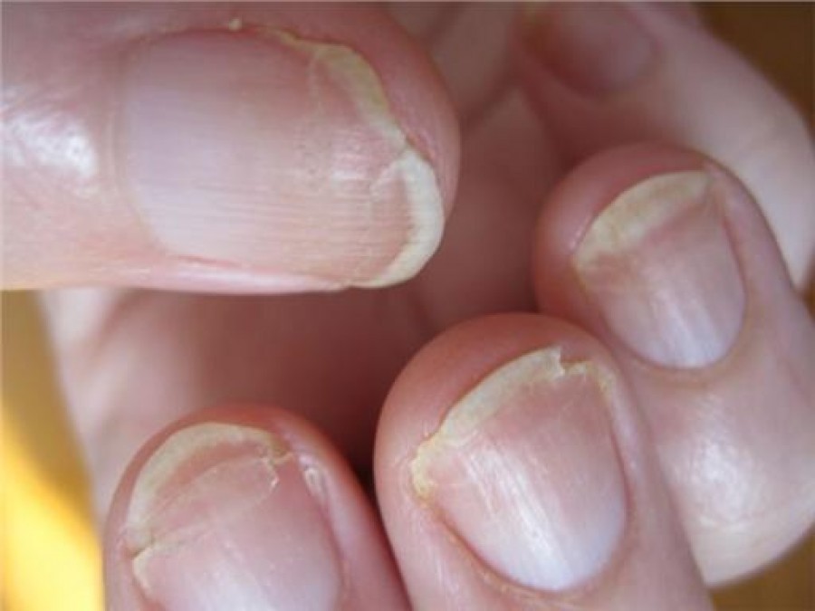 лечение грибковых заболеваний ногтей