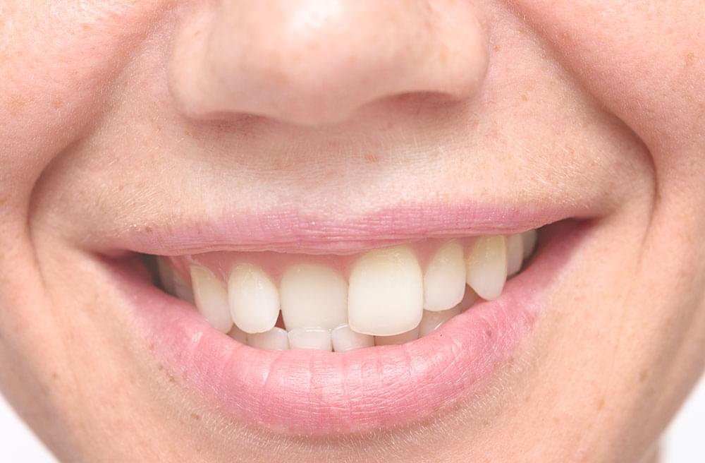 Причины криво растущих зубов 