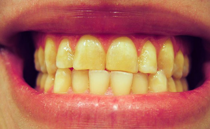 желтые зубы