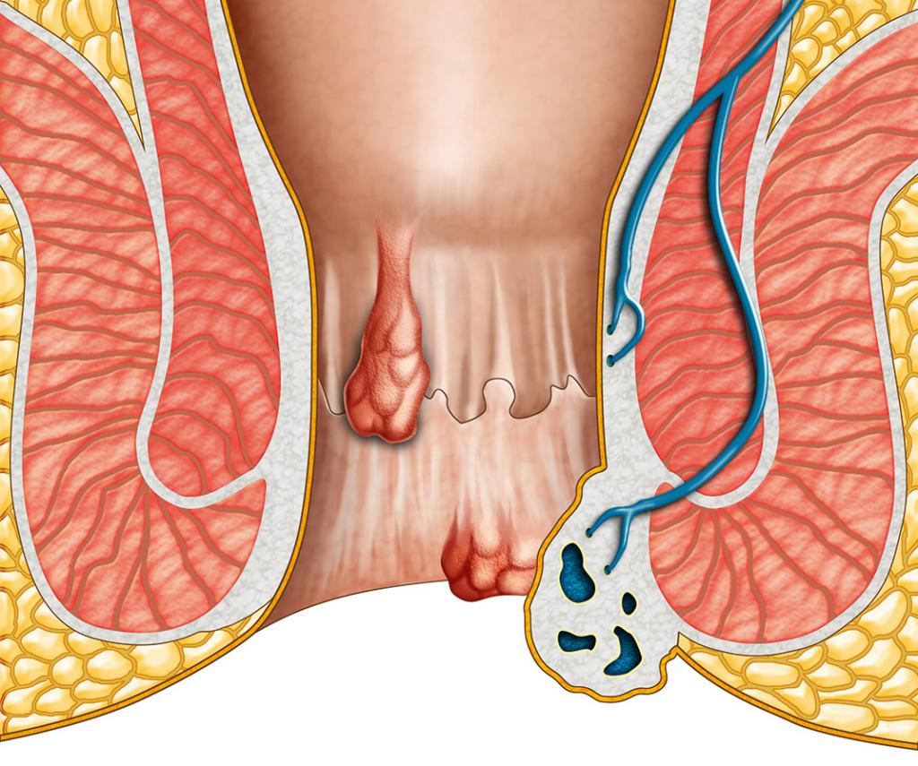 геморрой макет