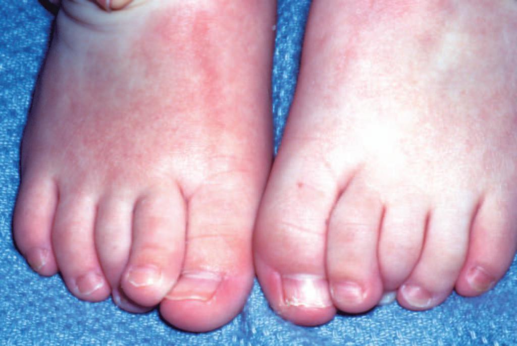 Панариций на ноге у ребенка фото