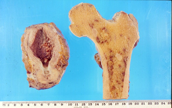 Bone metastases