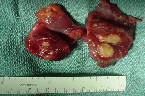 Вырезанная щитовидная железа, пораженная раковой опухолью