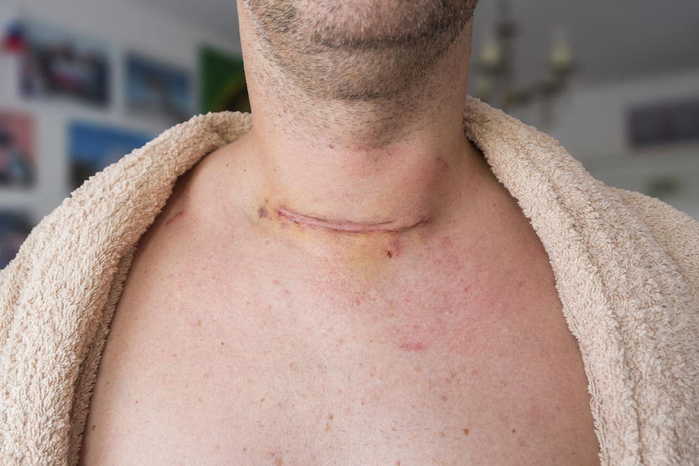 Шов после операции на щитовидной железе