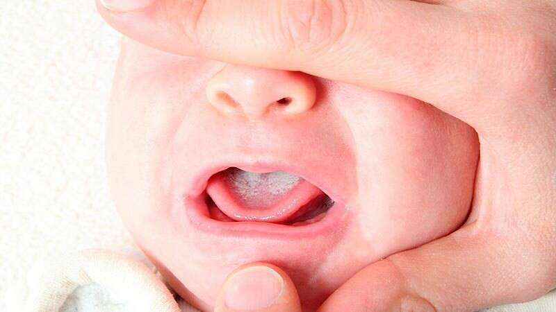 Молочница во рту у новорожденных