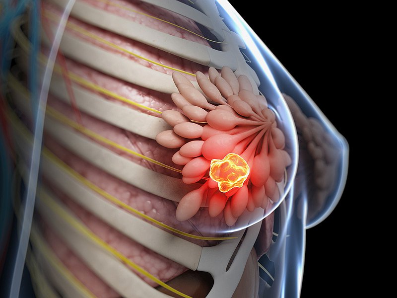 Фото рака молочных желез у женщин