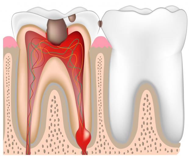 как лечить пульпит